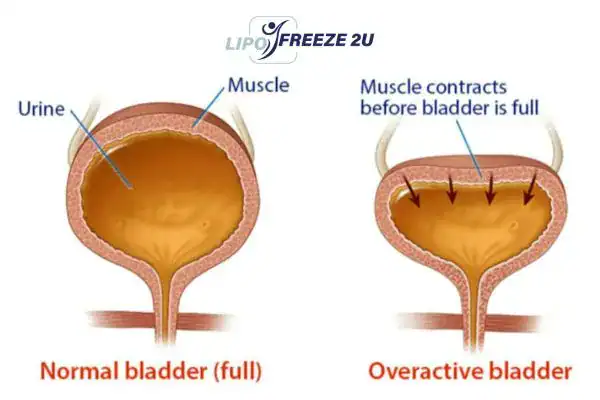 diagram of overactive bladder treatment Avon