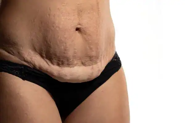 loose skin after weight loss injections Avon