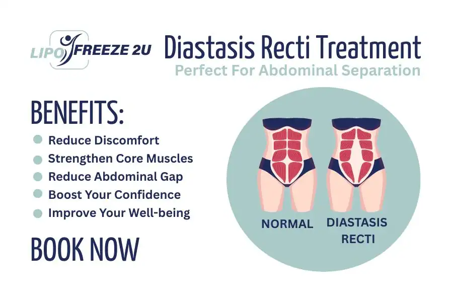 How Long Will It Take to See Improvements in Diastasis Recti Avon