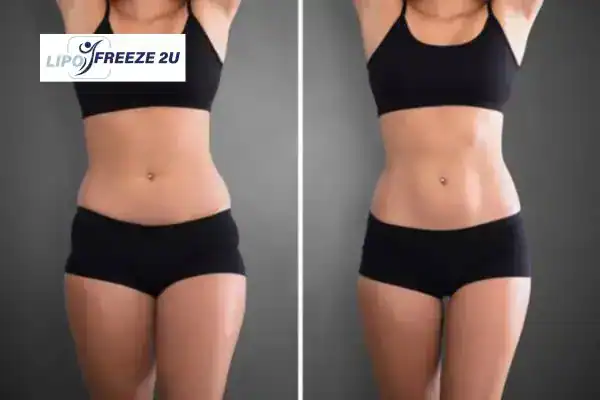 How Can LIPO FREEZE 2U Support Your Post-Pregnancy Body Recovery Avon?