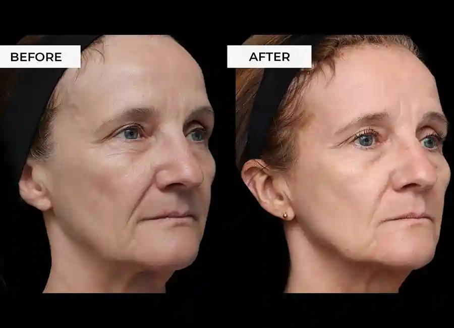 How Many RF Microneedling Sessions Will You Need to See a Difference Avon?