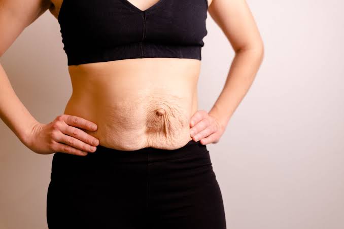 Is Surgery Really the Only Way to Repair Diastasis Recti Avon?