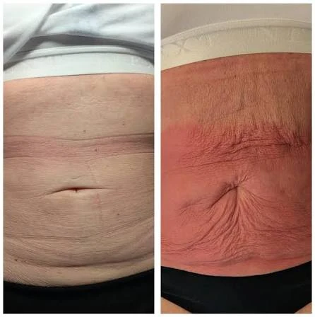 How Does RF Microneedling Improve Crepey, Thin and Uneven Skin Texture Avon?