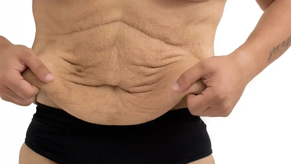 RF Microneedling for Loose Skin: How Can It Help Tighten and Reshape the Skin Avon?